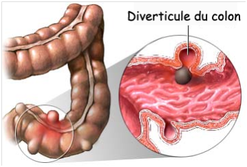 Diverticulite sigmoïdienne compliquée : sigmoïdite compliquée ...