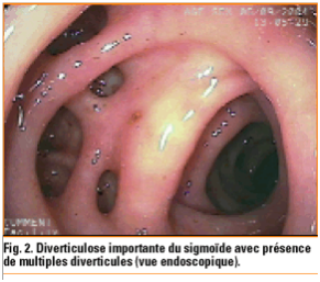 Diverticulite sigmoïdienne compliquée : sigmoïdite compliquée ...