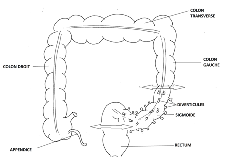 Diverticulite sigmoïdienne compliquée : sigmoïdite compliquée ...