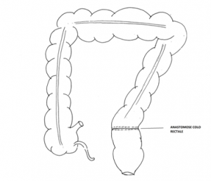 Diverticulite sigmoïdienne compliquée : sigmoïdite compliquée – Centre ...