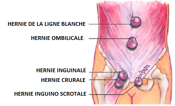 Qu'est ce qu'une hernie ? – Centre de chirurgie digestive Lyon